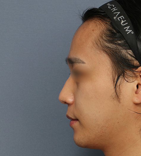 Before 3 Side