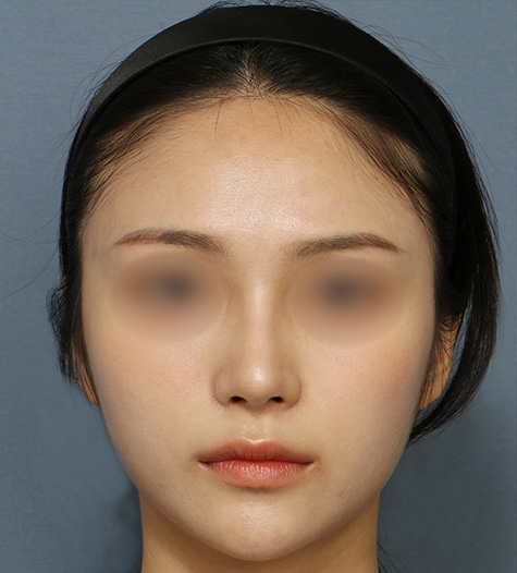 Before 8 Front