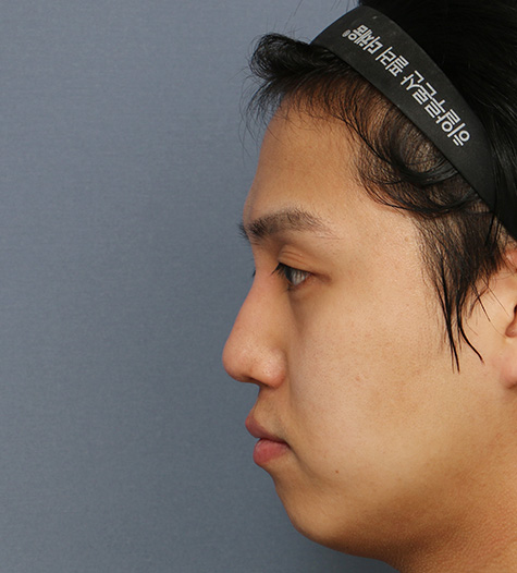 Before 6 Side