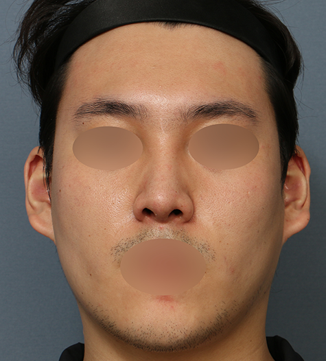 Before 12 Front