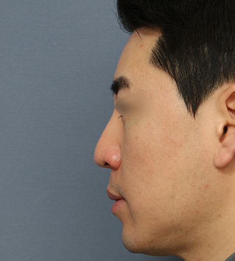 Before 10 Side