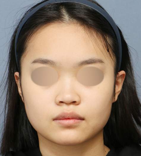 Before 3 Front