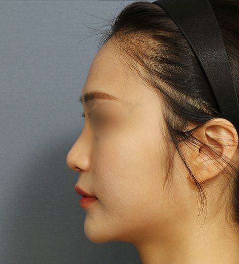 Before 8 Side