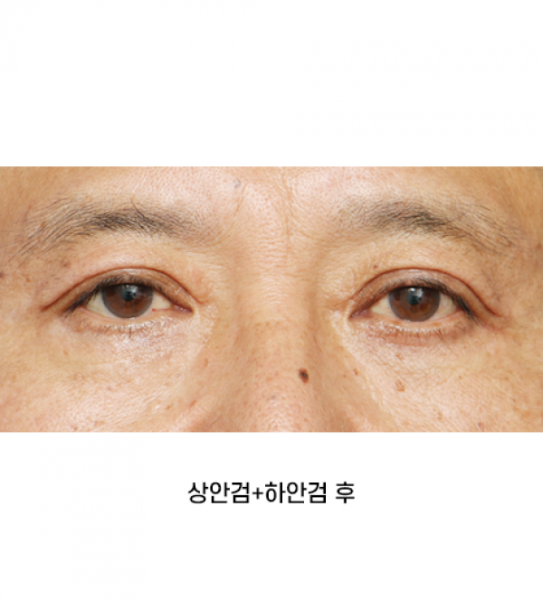 상안검+하안검