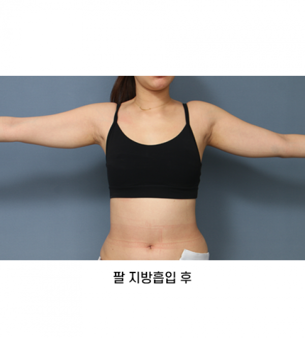 팔 지방흡입