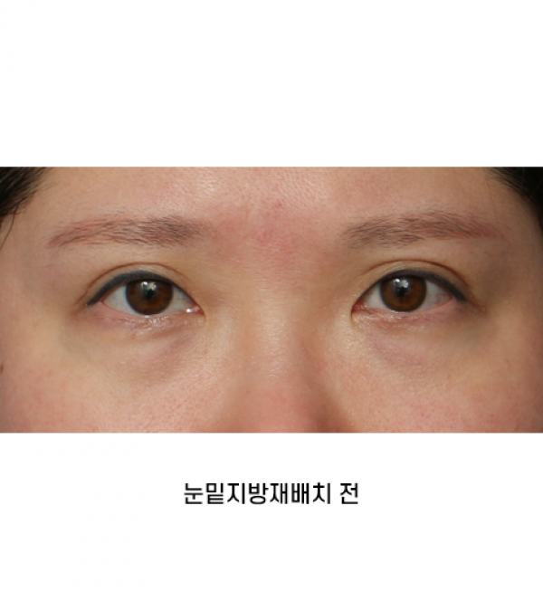 눈밑지방재배치