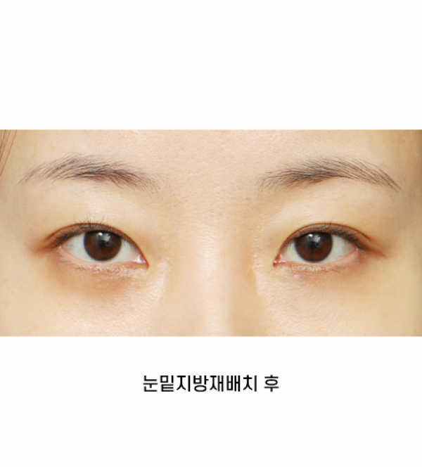 눈밑지방재배치