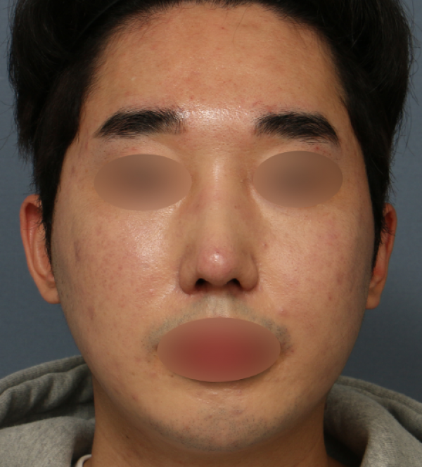 코수술