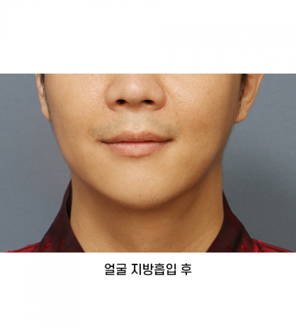 얼굴 지방흡입