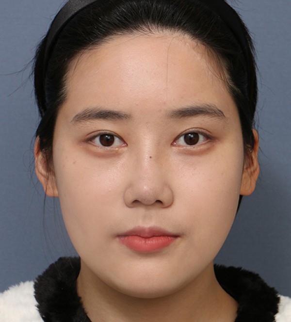 코수술