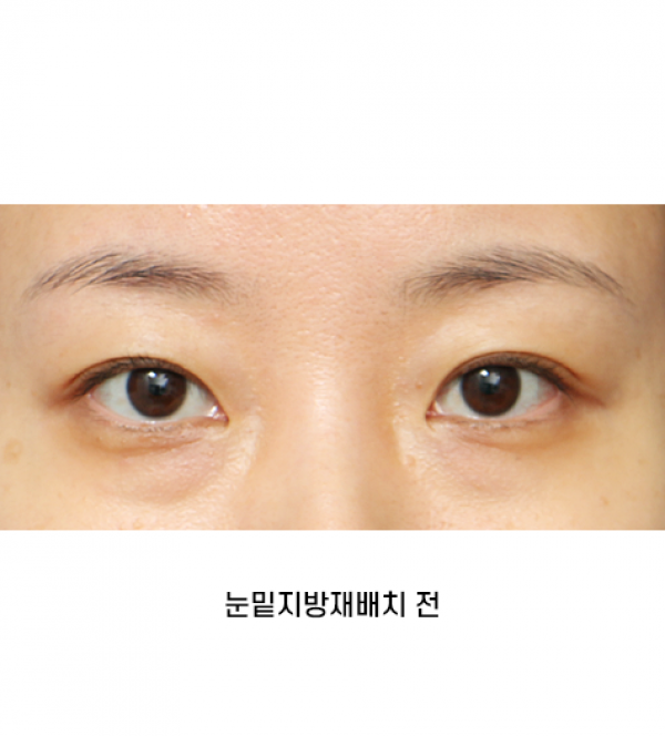 눈밑지방재배치