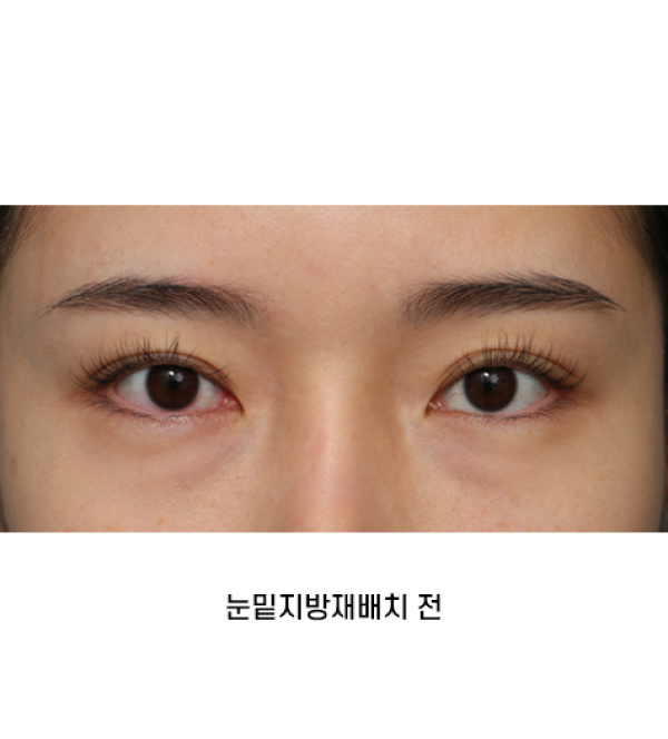 눈밑지방재배치