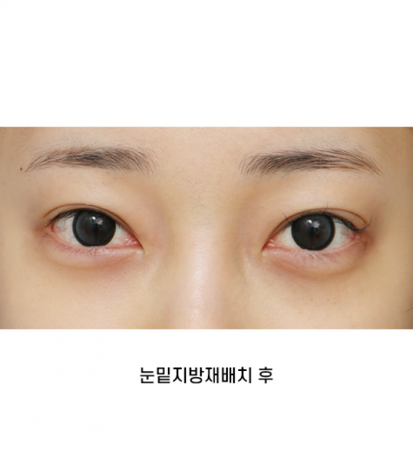 눈밑지방재배치