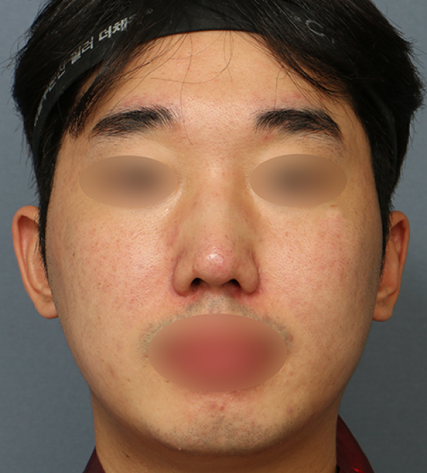 코수술