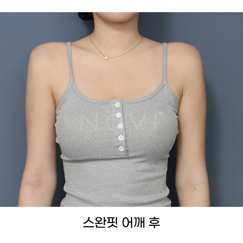 Before 10 Front
