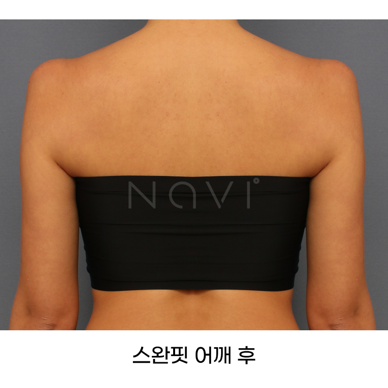 Before 10 Front