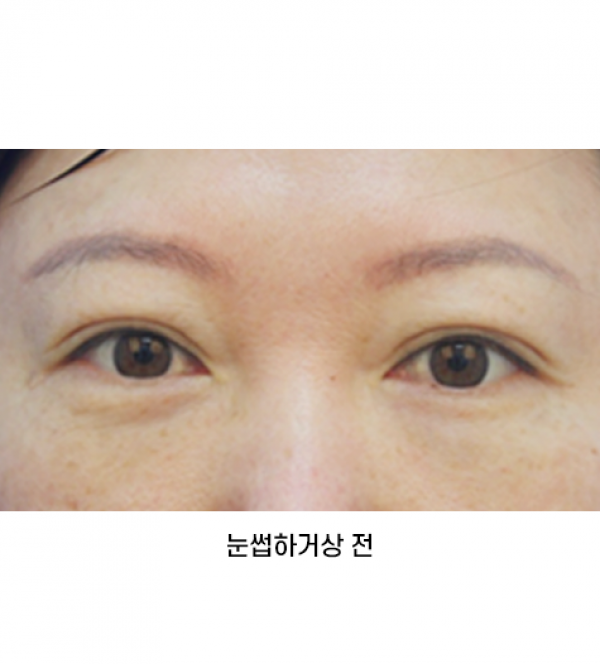 눈썹하거상