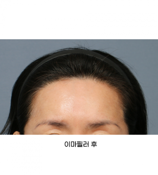 이마필러