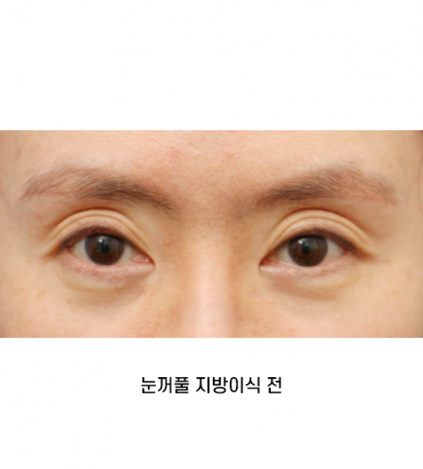 눈꺼풀 지방이식
