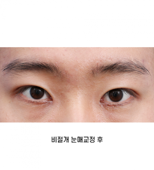 남자 눈성형