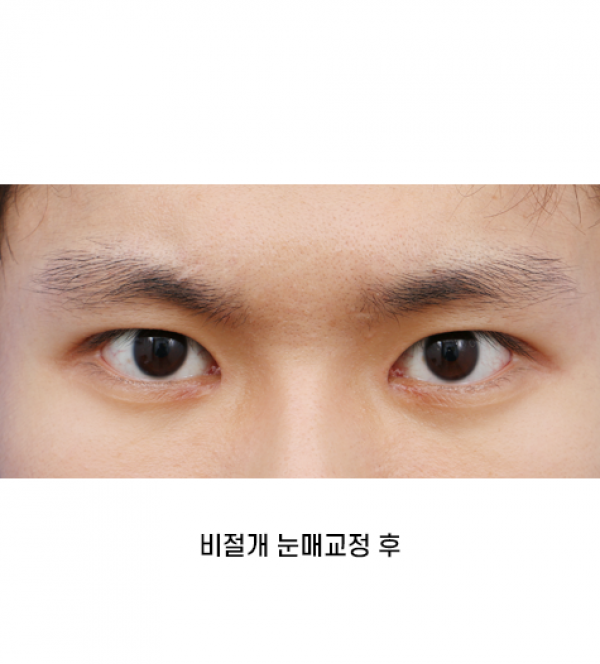 남자 눈성형