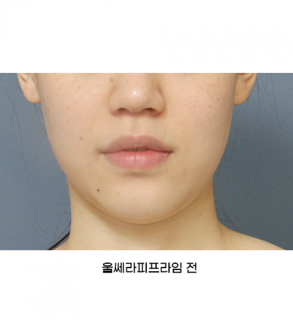 울쎄라피프라임