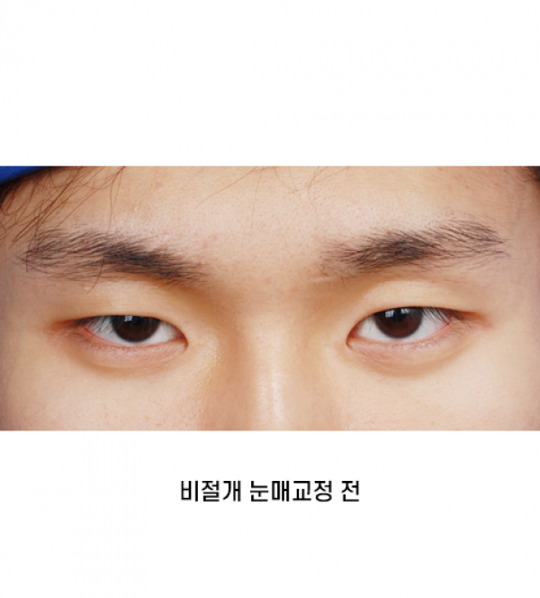 남자 눈성형