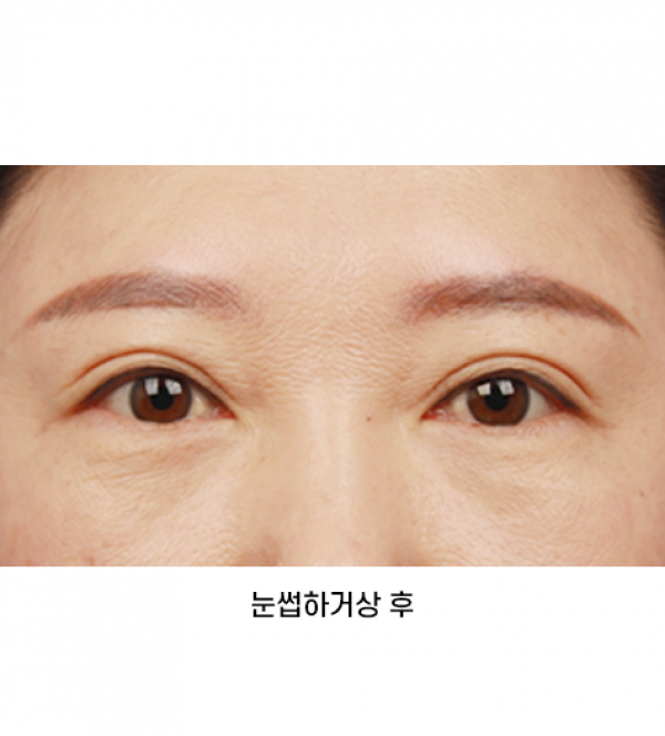 눈썹하거상