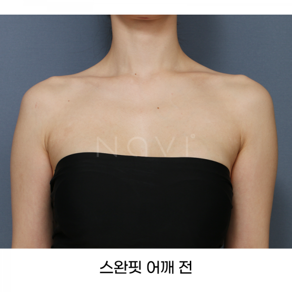 스완핏 어깨