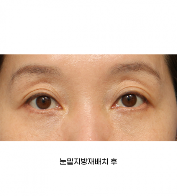 눈밑지방재배치
