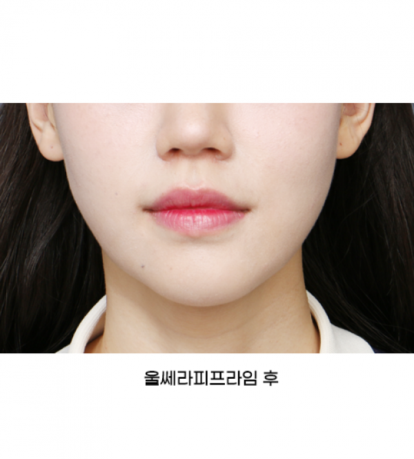 울쎄라피프라임